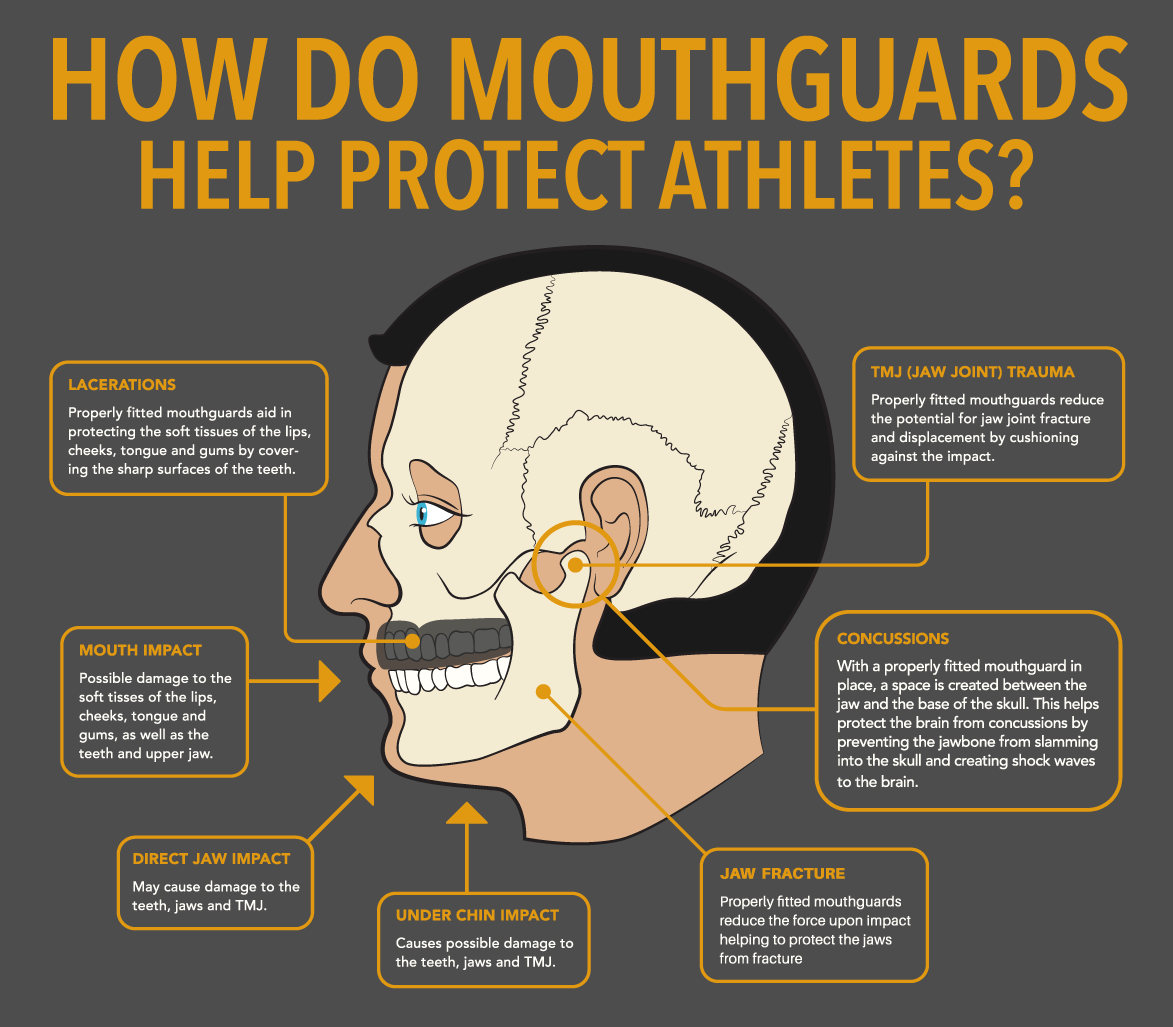 Mouthguard Mouthguard